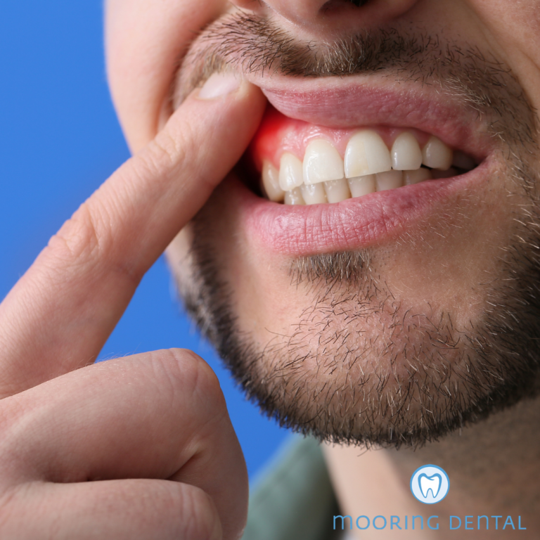 Understanding Periodontal Disease Protecting Your Smile And Overall